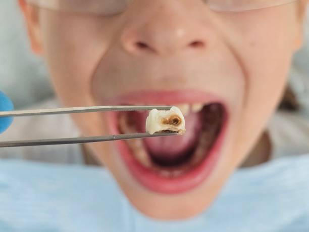 Best Emergency Tooth Extraction in Hinton, WV